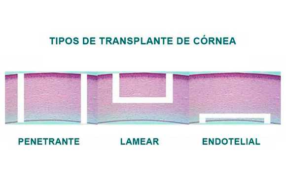 Imagem Quais os tipos de Transplante de Córnea?